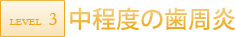 レベル3　中程度の歯周炎